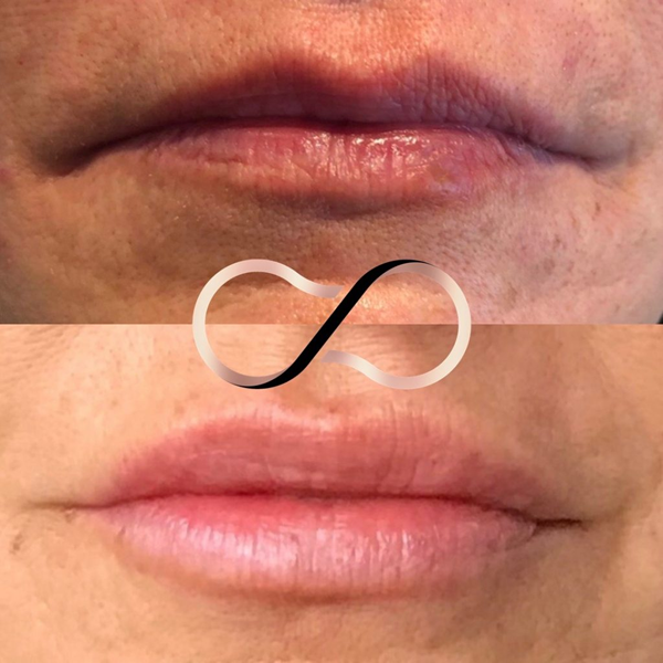 Before And After Lip Fillers Cosmetic Perfection Merseyside