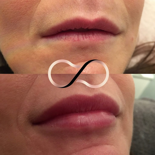 Before And After Lip Fillers Cosmetic Perfection Merseyside