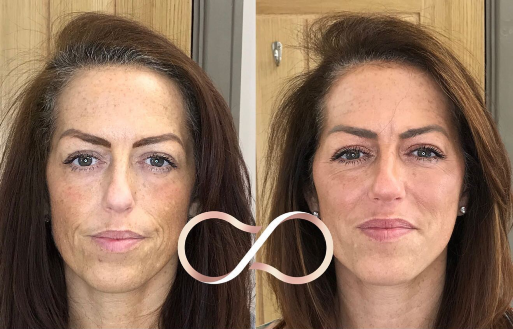 Collagen Preservation Before And After Cosmetic Perfection