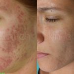 SkinPen Acne Scarring Before And After