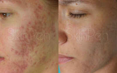 SkinPen Acne Scarring Before And After
