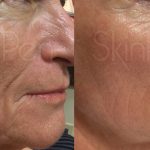 SkinPen Before And After