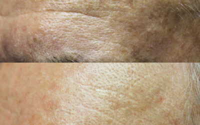 SkinPen Before And After