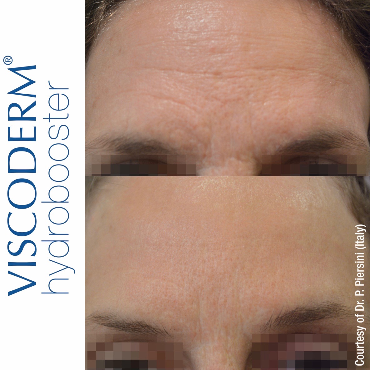 Viscoderm Hydrobooster Before And After