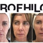 Profhilo Before And After