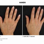 Profhilo Hands Before And After