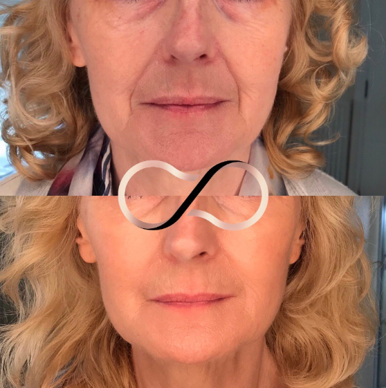 Dermal Fillers Before And After Cosmetic Perfection