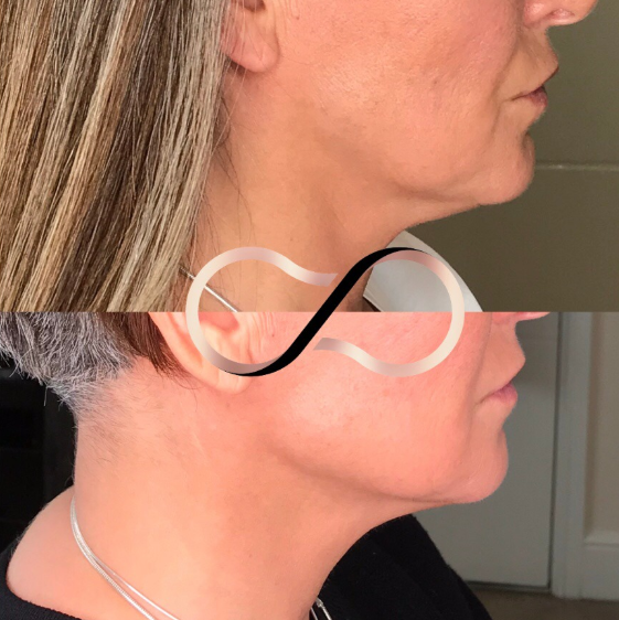 Dermal Fillers Before And After Cosmetic Perfection
