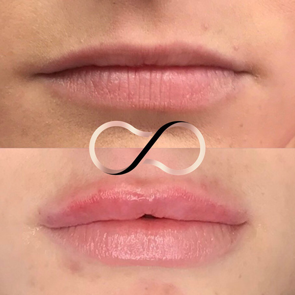 Before And After Lip Fillers Cosmetic Perfection Merseyside