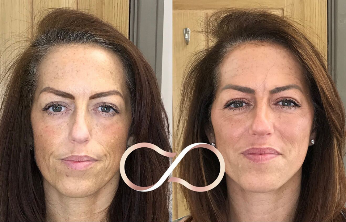 Collagen Preservation Before And After Cosmetic Perfection