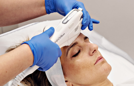 Cosmetic-Perfection-Aesthetics-Clinic-Wirral-Merseyside-Microneedling