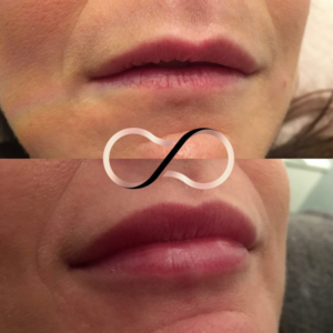 Lip-Fillers-Before-And-After-Cosmetic-Perfection-Wirral-Merseyside-Aesthetics