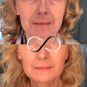 Dermal Fillers Cosmetic Perfection Wirral Aesthetic Clinic