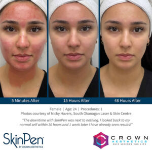 SkinPen Skin Treatment Wirral Merseyside Cosmetic Perfection