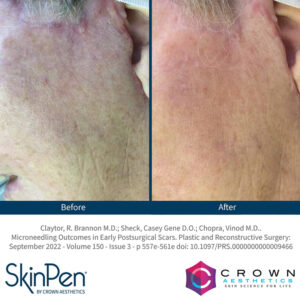 SkinPen Skin Treatment Wirral Merseyside Cosmetic Perfection