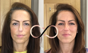 Cosmetic Perfection Wirral Dermal Filler Skincare WOW Facial