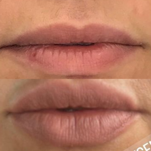 Dermal Filler Treatment Wirral