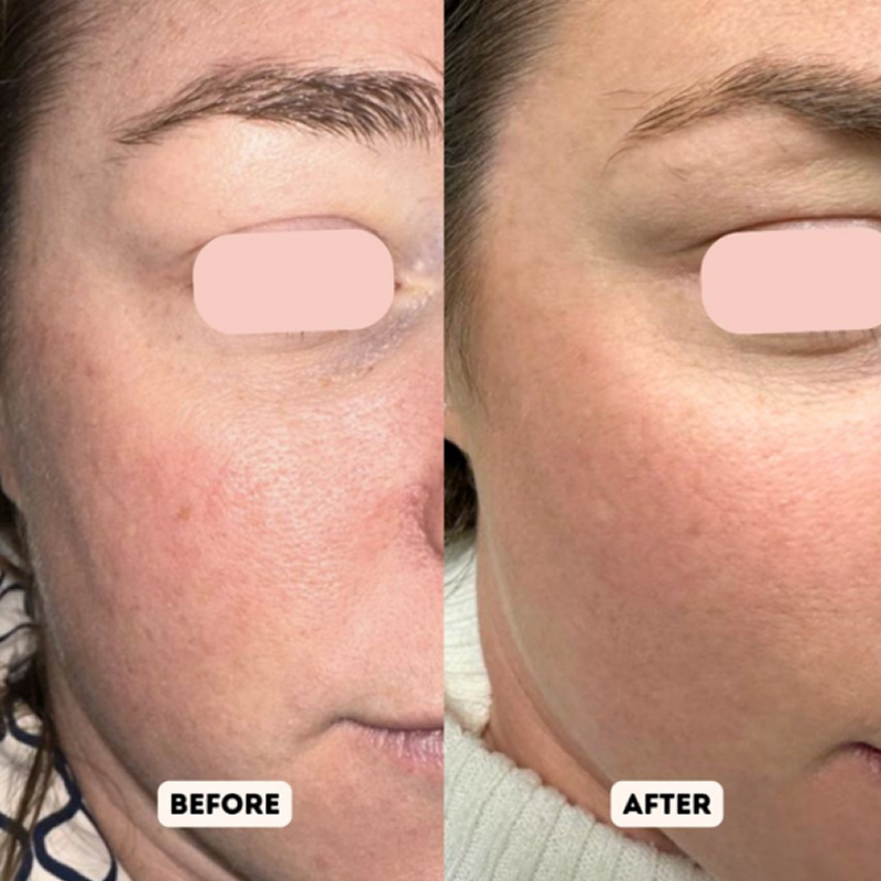 Exosomes Treatment UK Before And After