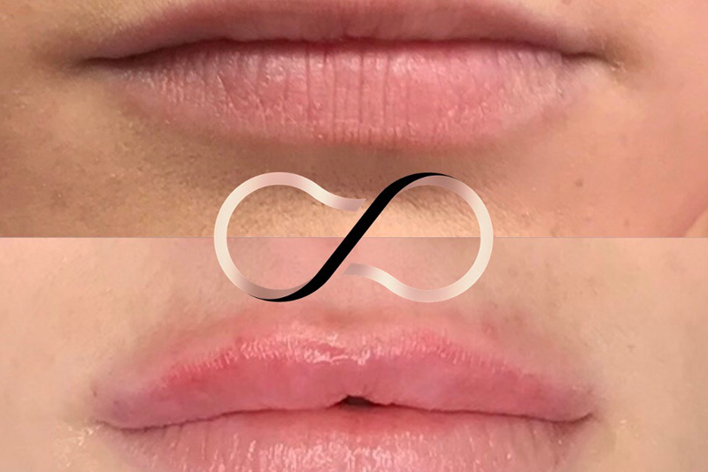 Lip Fillers Wirral