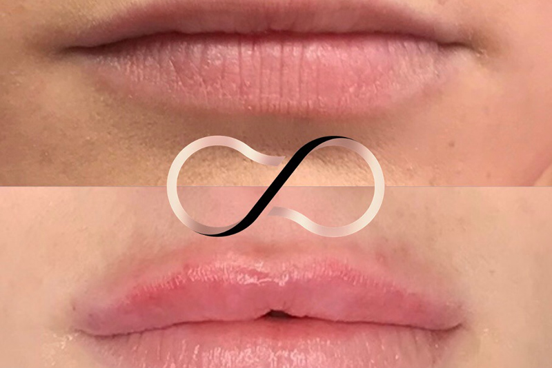 Lip Fillers Wirral