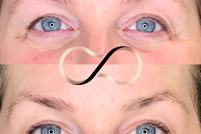 Botox In Wirral Anti Wrinkle Injections