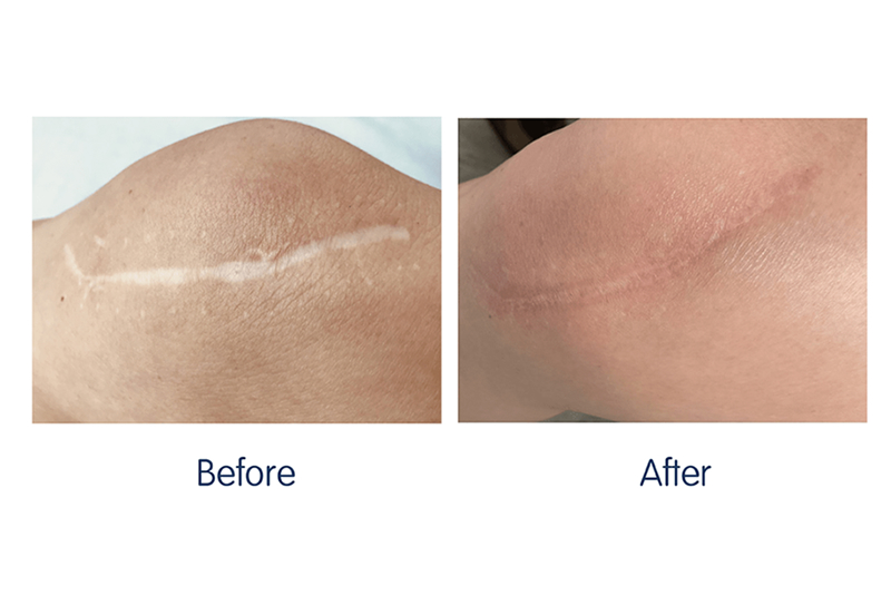Scar Treatment Wirral Merseyside Focus Dual
