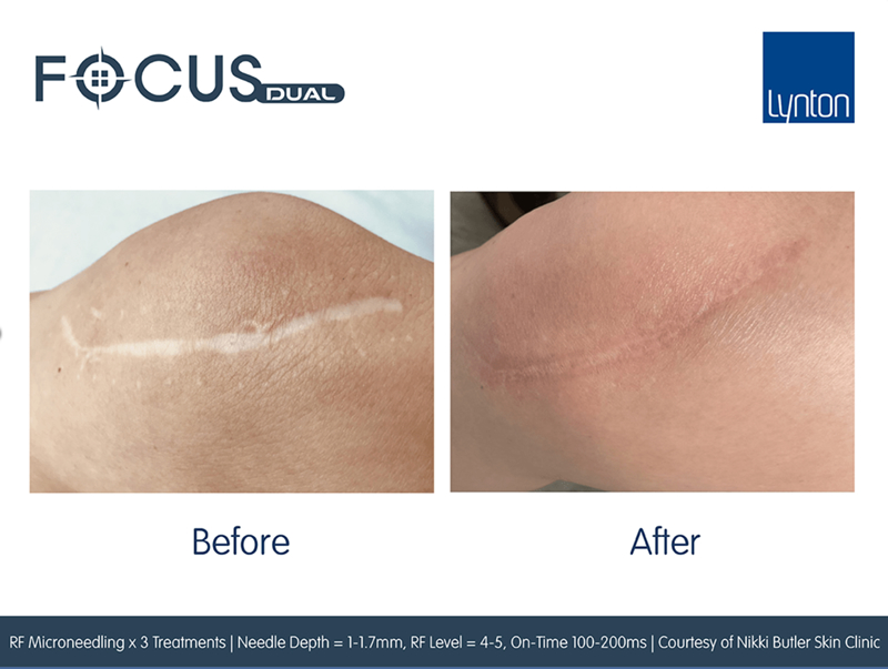 Scar Treatment Wirral Merseyside Focus Dual