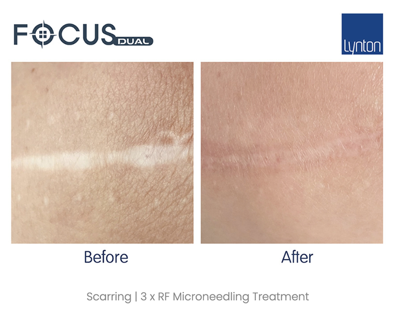 Scar Treatment Wirral Merseyside Focus Dual
