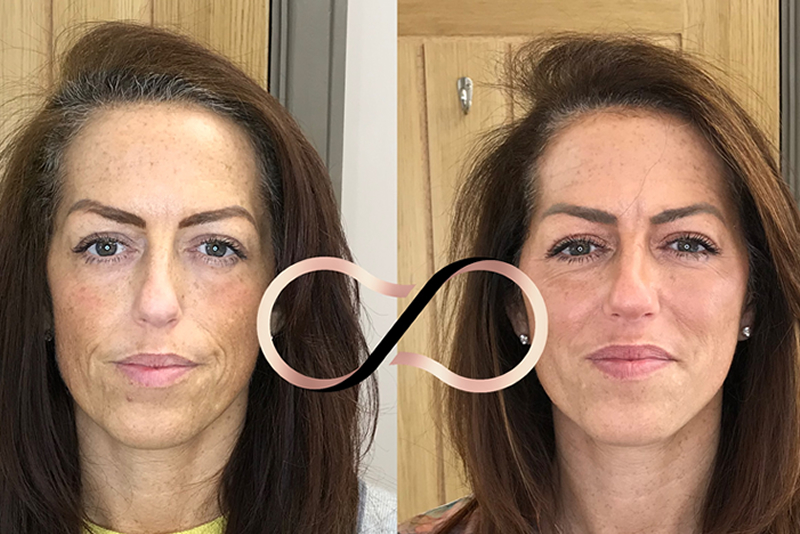 Dermal Filler Wirral