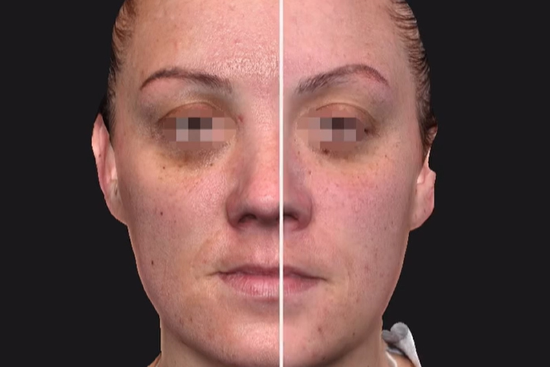 Radiofrequency Microneedling & Exosomes