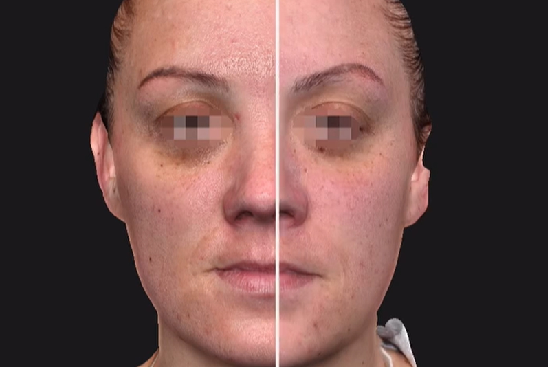 Radiofrequency Microneedling & Exosomes