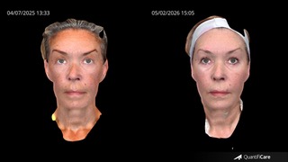 Full Face Rejuvenation Aesthetics Wirral